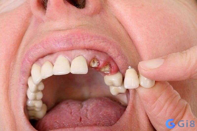 Ngủ mơ răng rụng và chảy máu thì nhiều người tin rằng đây là dấu hiệu không may mắn Ngủ mơ răng rụng và chảy máu thì nhiều người tin rằng đây là dấu hiệu không may mắn